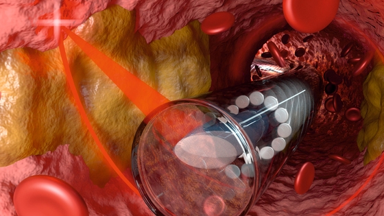 3D-printed micro lens-in-lens in a valve